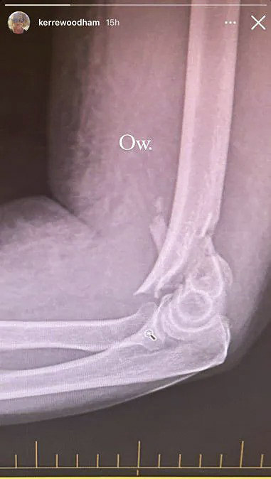 Kerre's body weight landed on her elbow, smashing it badly. Photo / NZ Woman's Weekly