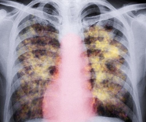 Silica dust scars the lungs which makes it difficult to take in oxygen. Stock photo by Alamy
