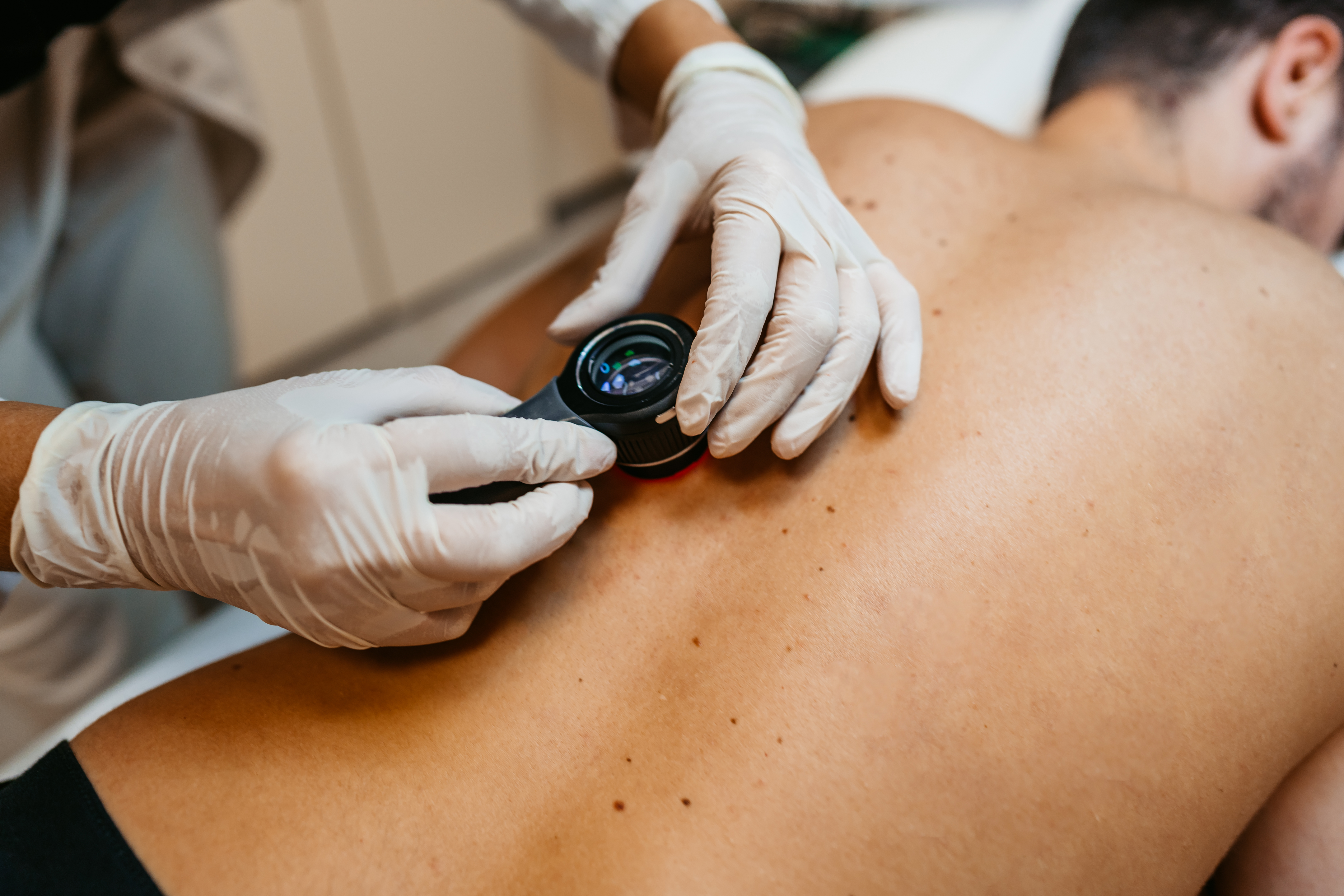 If primary melanomas are caught early, then patients tend to have very good outcomes. Photo / Getty Images