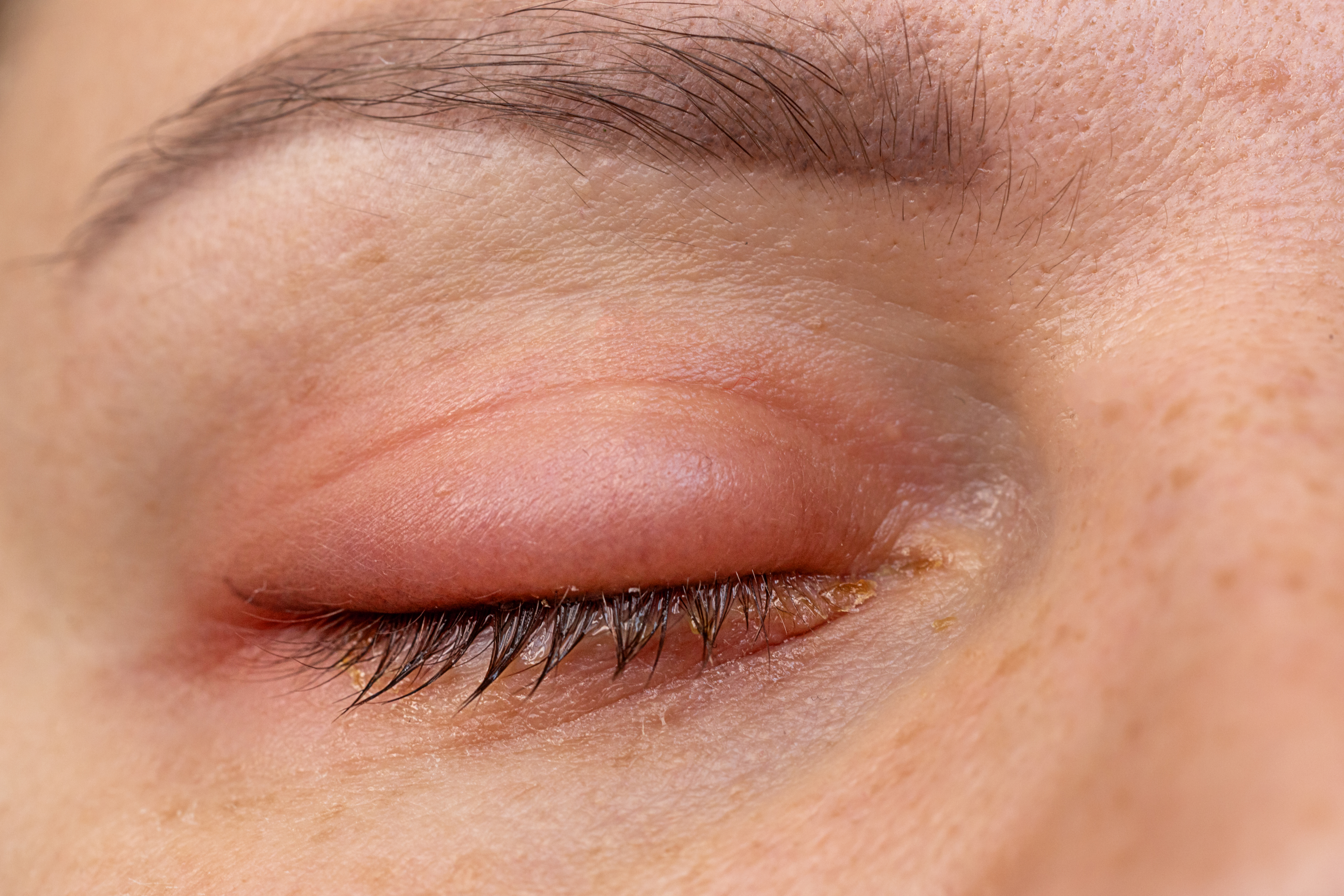 From psoriasis to Sjögren’s syndrome, there are a range of inflammatory conditions characterised by dry eyes or a dry mouth. Photo / Getty Images