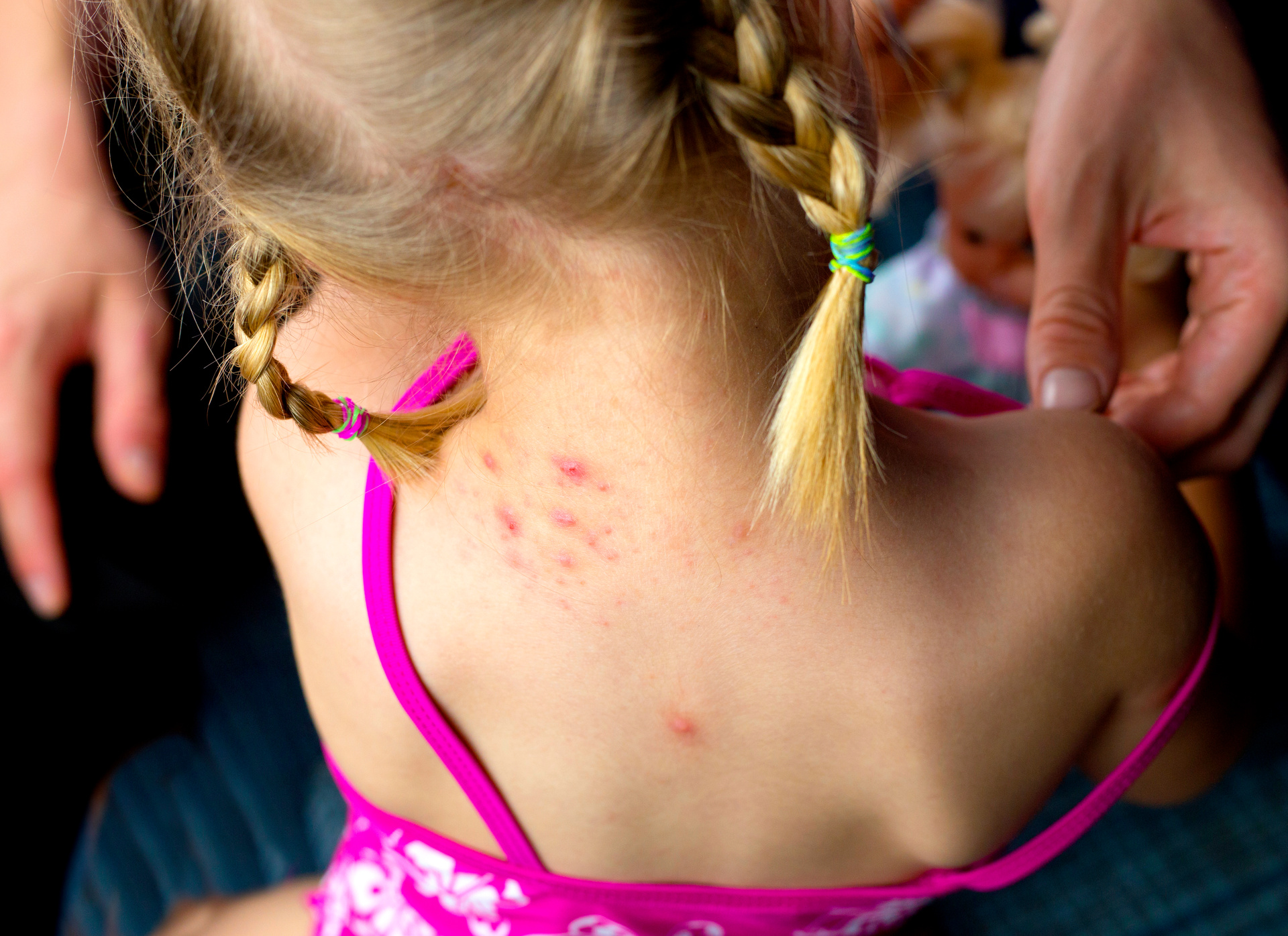 Around half of children in South Auckland are declined a specialist appointment for serious skin conditions. Photo / File