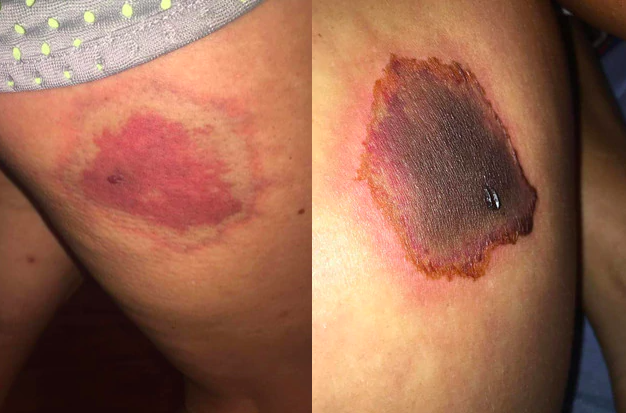Progression and healing of a spider bite