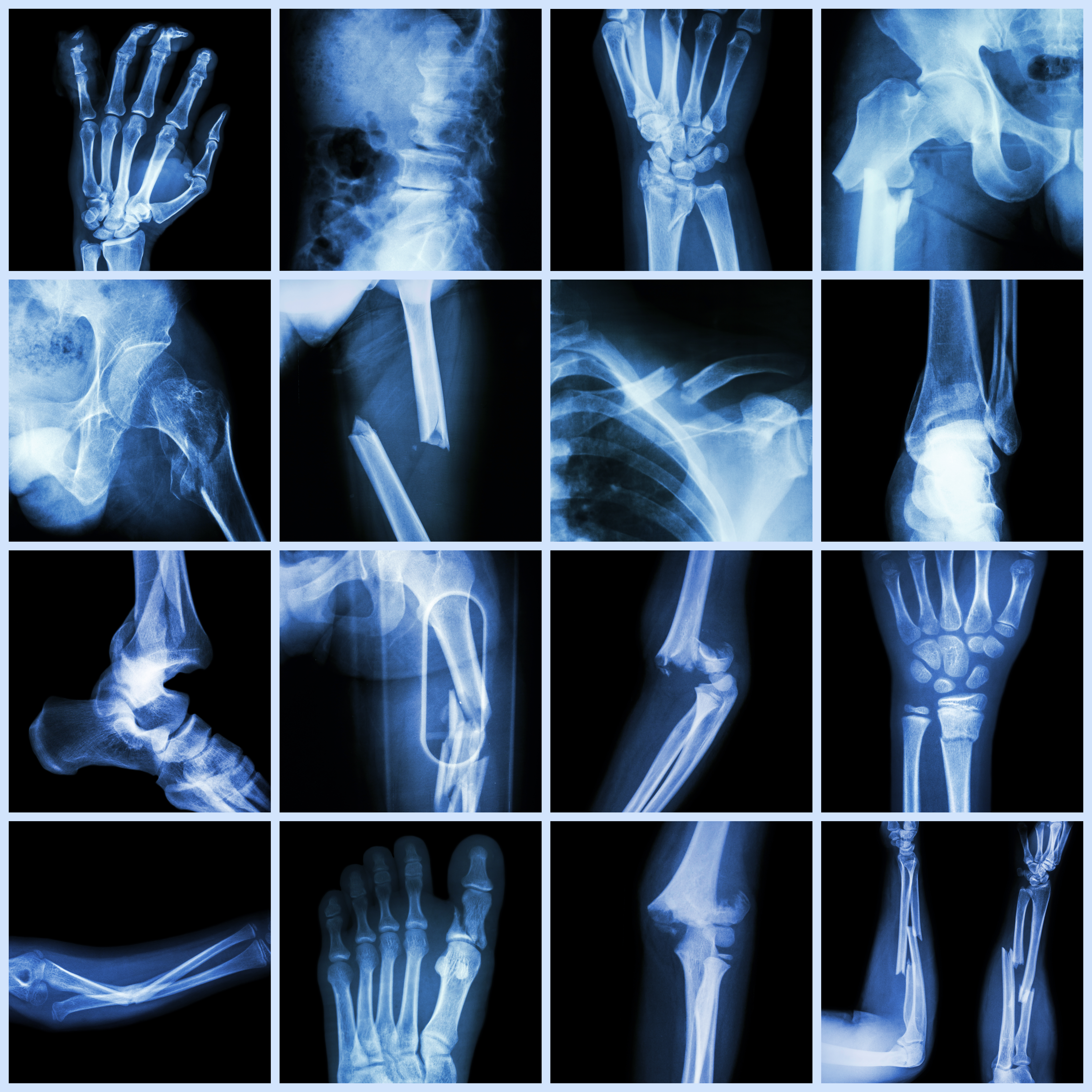 The fact that we’re living longer is one reason bone health is becoming more of a focus for innovative research. Photo / Getty Images