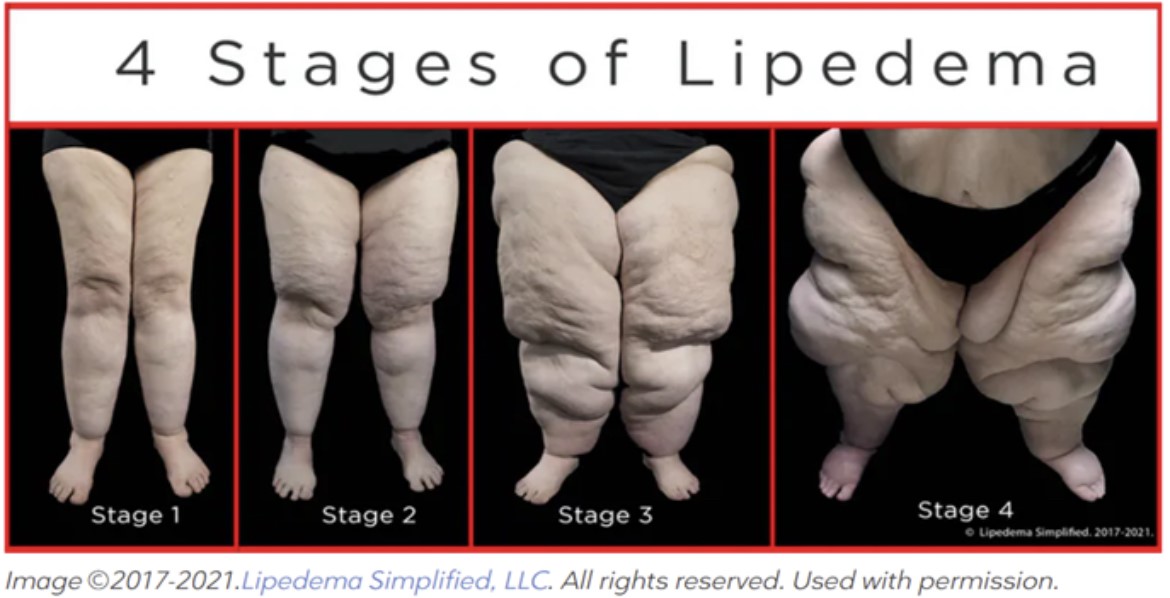 Lipedema Awareness Month: Women are often overlooked due to a lack of  awareness of the illness - NZ Herald