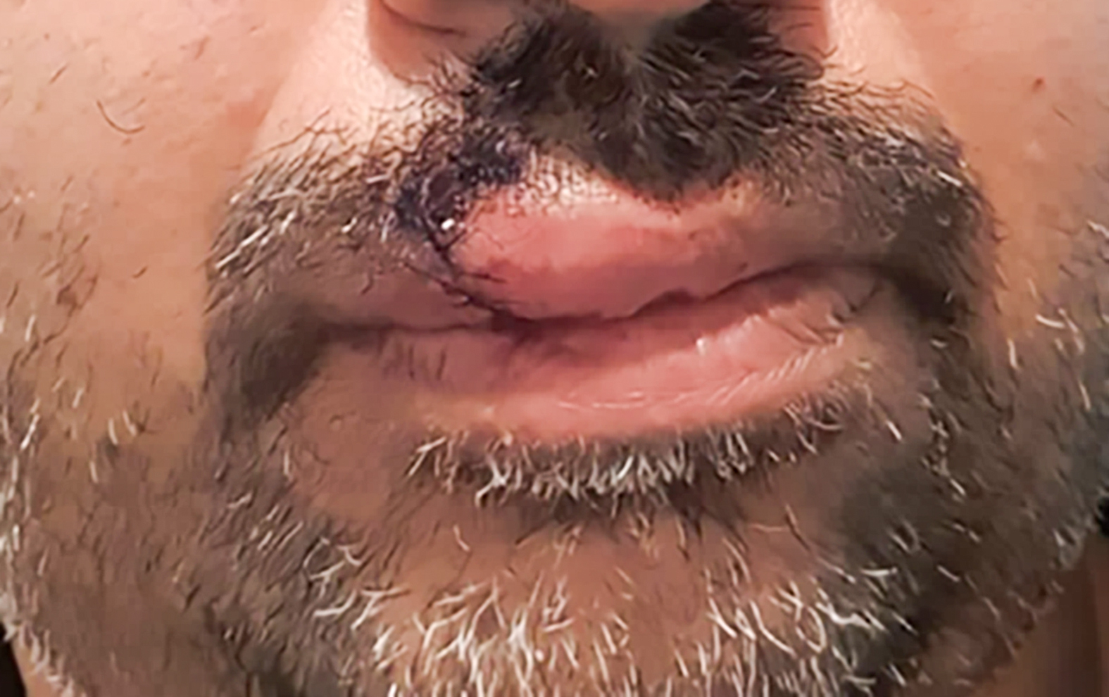 A plastic surgeon was was needed to stitch up the deep gash in Aaron's lip from the assault. Photo / Supplied