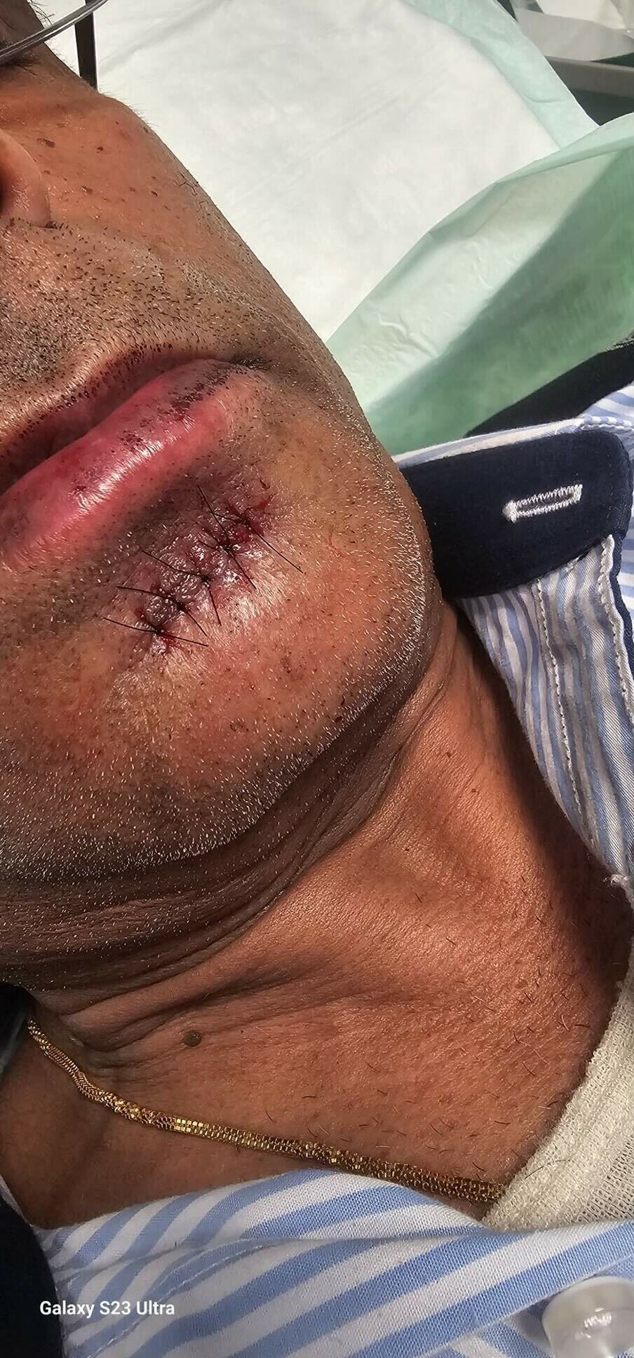Trehan's facial wound required five stitches. Urgent dental care will follow for a dislodged tooth.