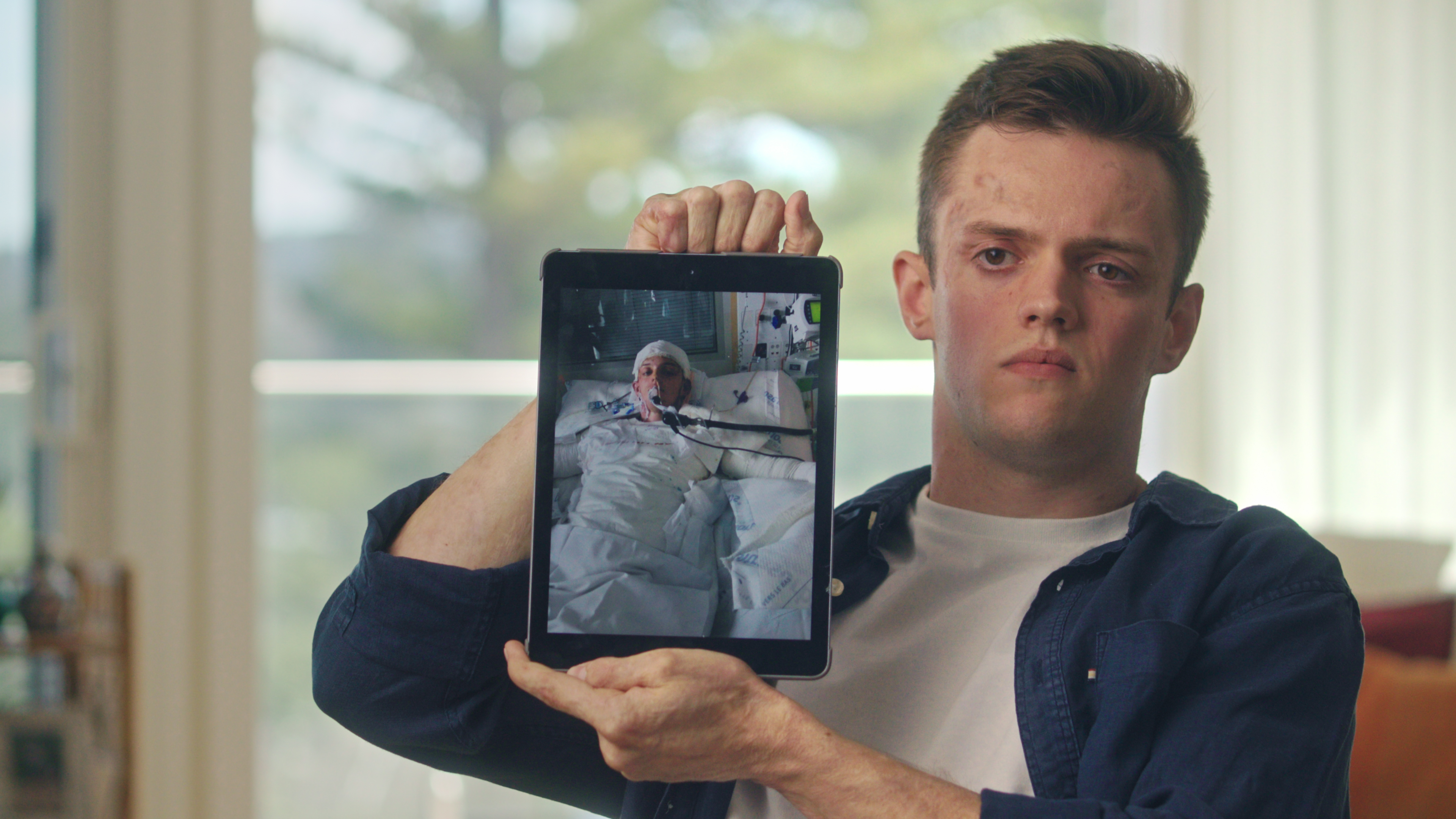 Jesse Langford spent eight days in a coma and two months in hospital after the eruption. Photo / Supplied
