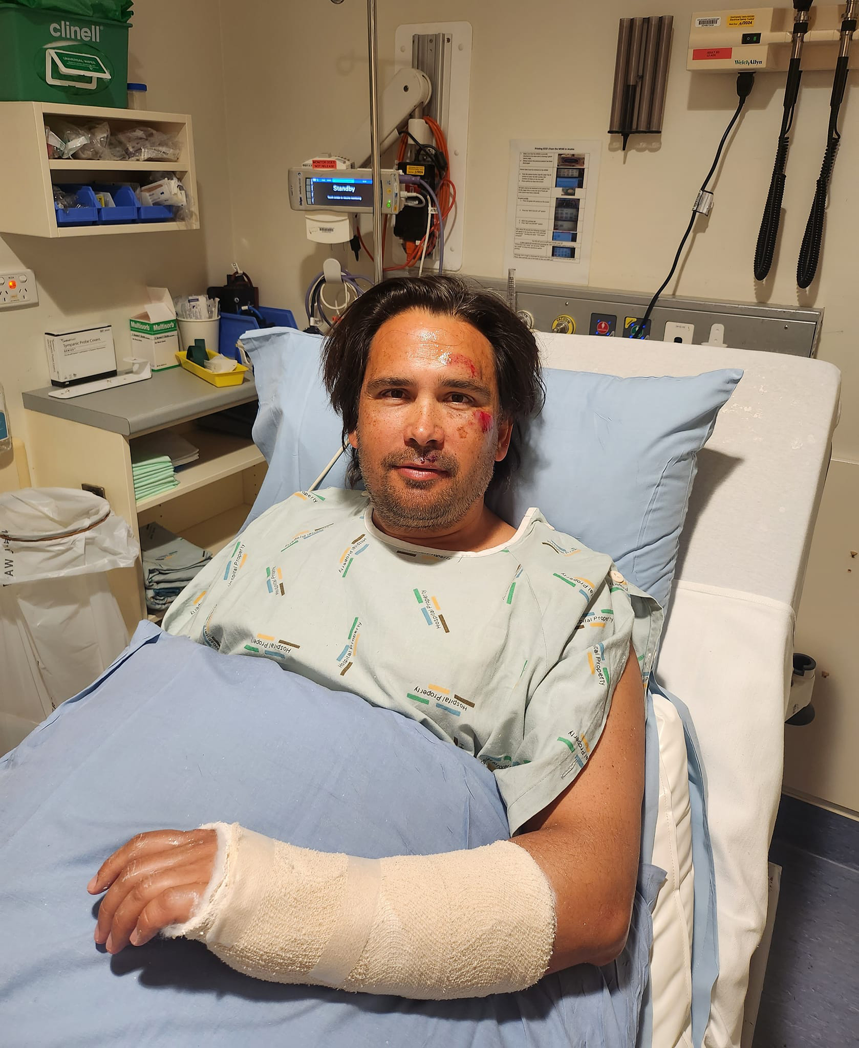 Bridges said he had broken his wrist as well as hurt his face.