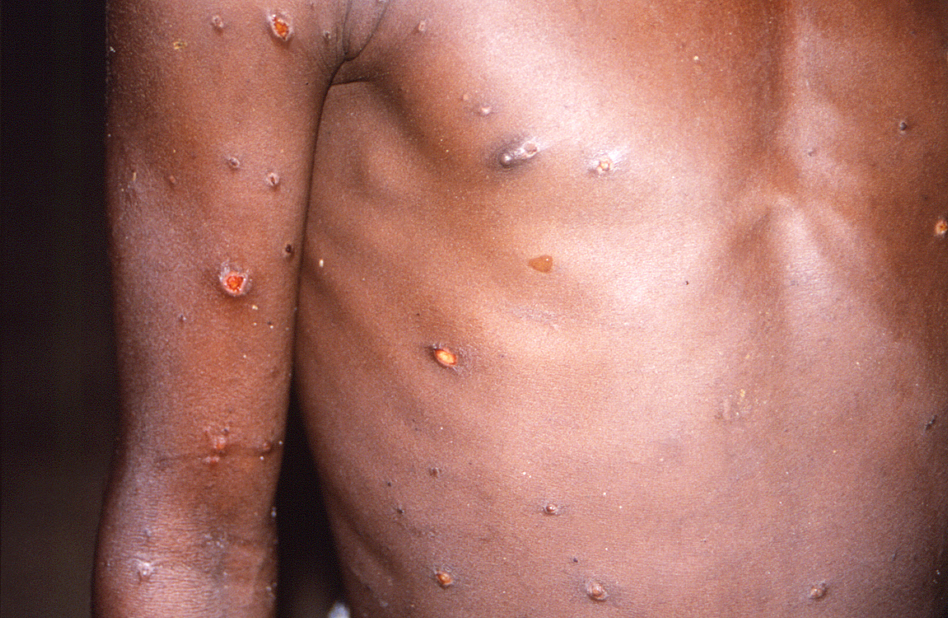 Monkeypox outbreak: Cases linked to adult sauna, fetish festival - NZ Herald