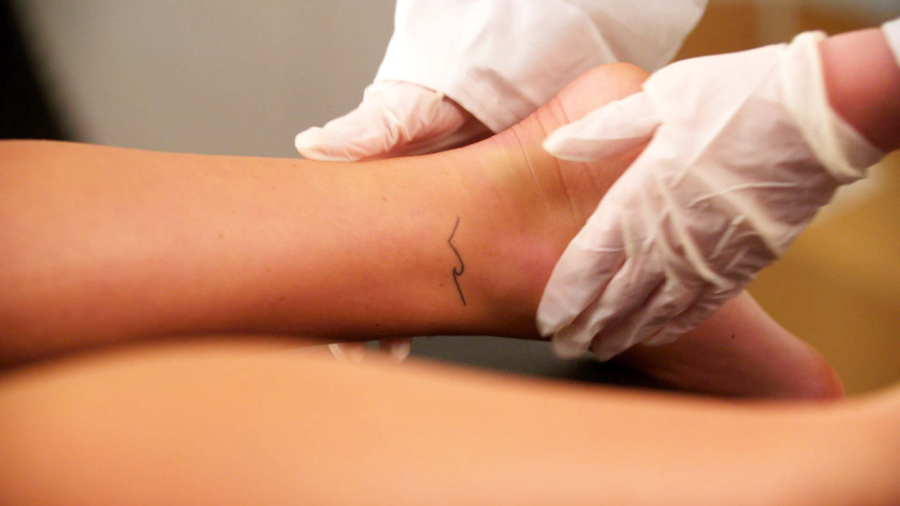 Discover more than 70 laser hair removal tattoo  thtantai2