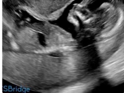 An ultrasound of Harrison. (Source: Givealittle)
