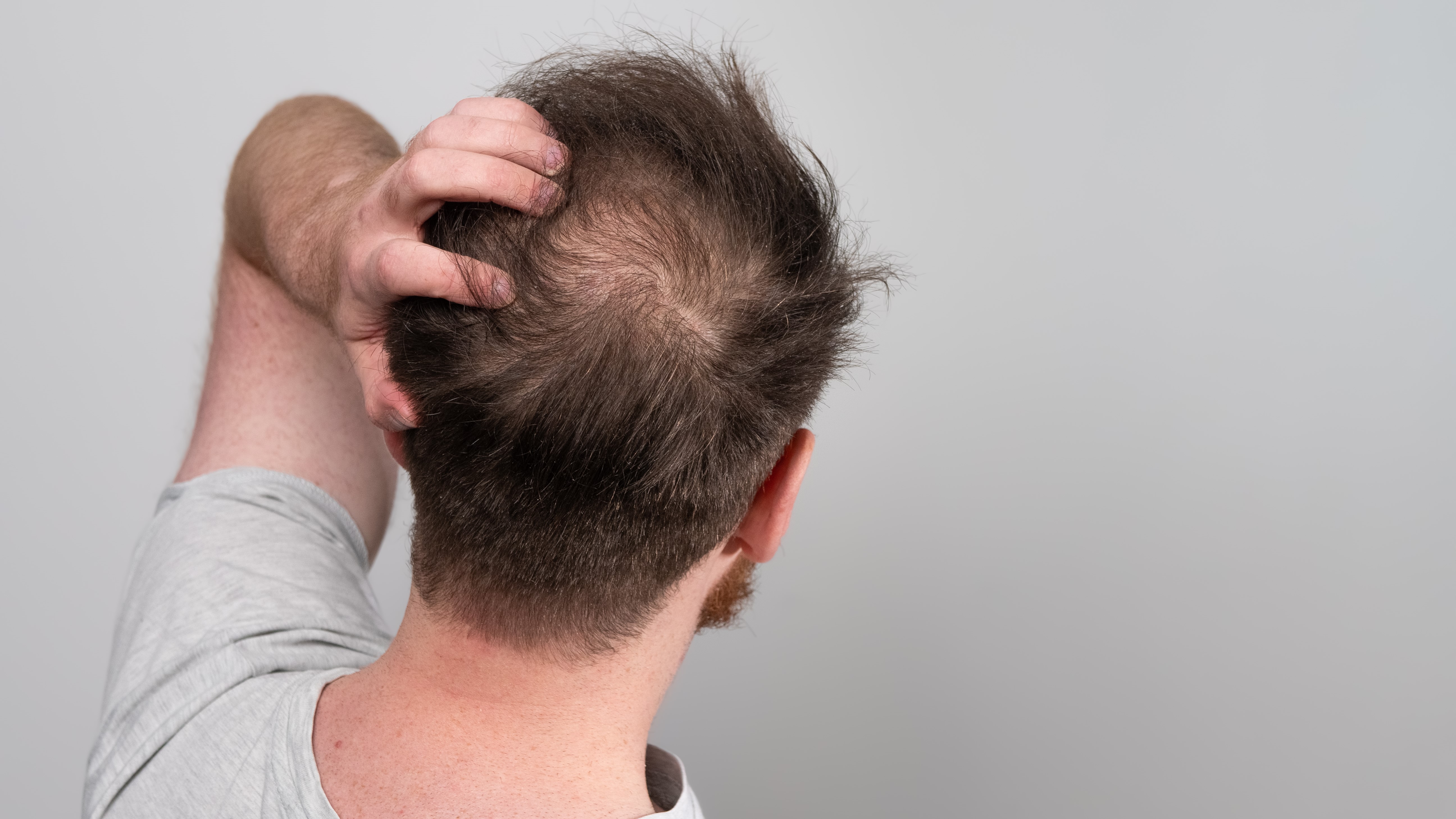 Sugary drinks linked to hair loss in younger men - study