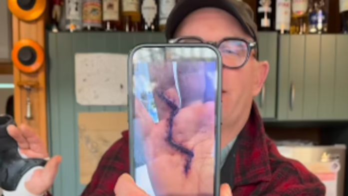 Hand surgery left Brown with a lightning scar, which he compares to Harry Potter's